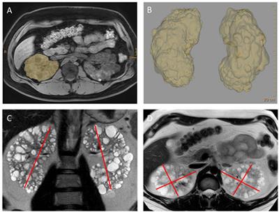 Cystic Kidney Diseases From the Adult Nephrologist’s Point of View